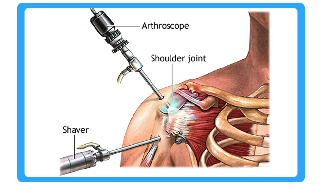 arthroscopy-surgery-in-bhiwandi-thane arthroscopy-surgery-in-bhiwandi-thane